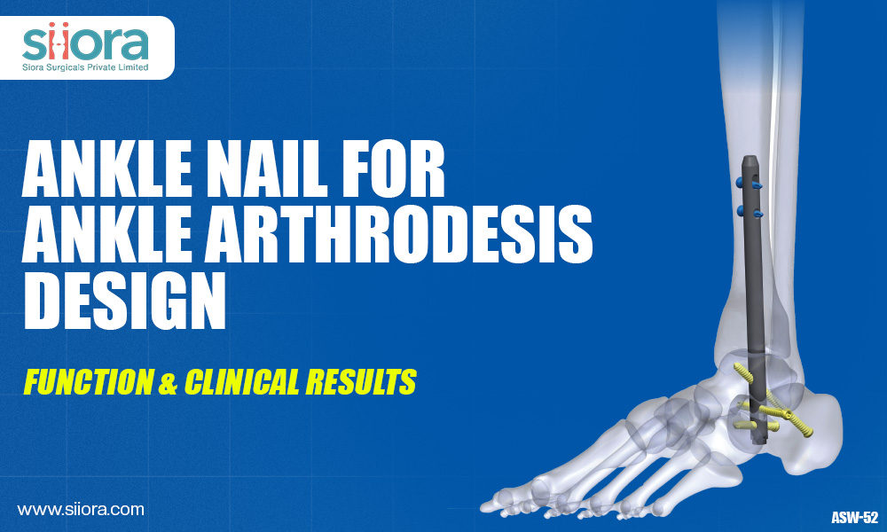 Ankle Nail for Ankle Arthrodesis: Design, Function & Clinical&nbsp;Results